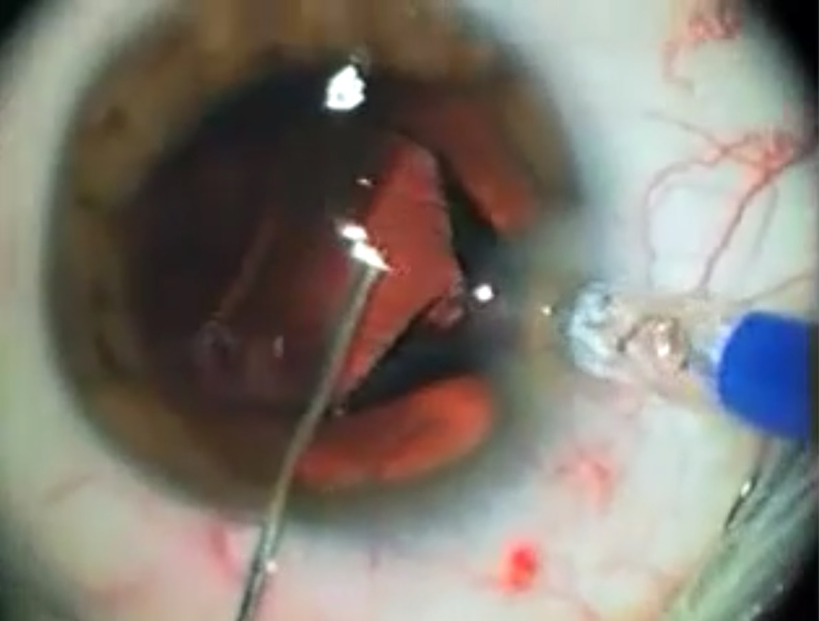 cataracte chirurgie