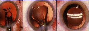 chirurgie-cataracte-implant