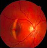 OCT-retine-1
