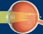 oeil-astigmate-vision