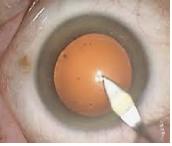 opération cataracte incision