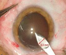 Operation-Cataracte-Microincision