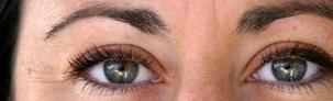 yeux-implants-cornee